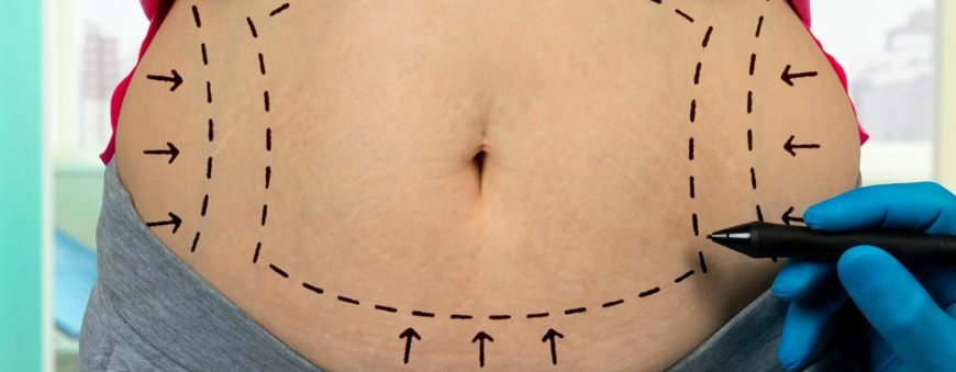 Does Fat Return After Liposuction Surgery?