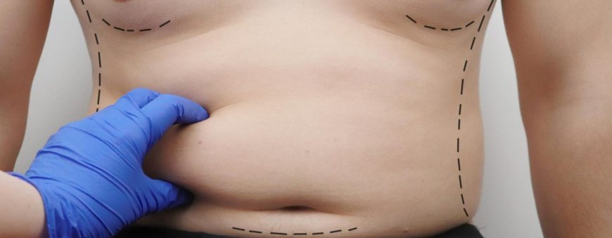 Liposuction to Remove Belly Fat