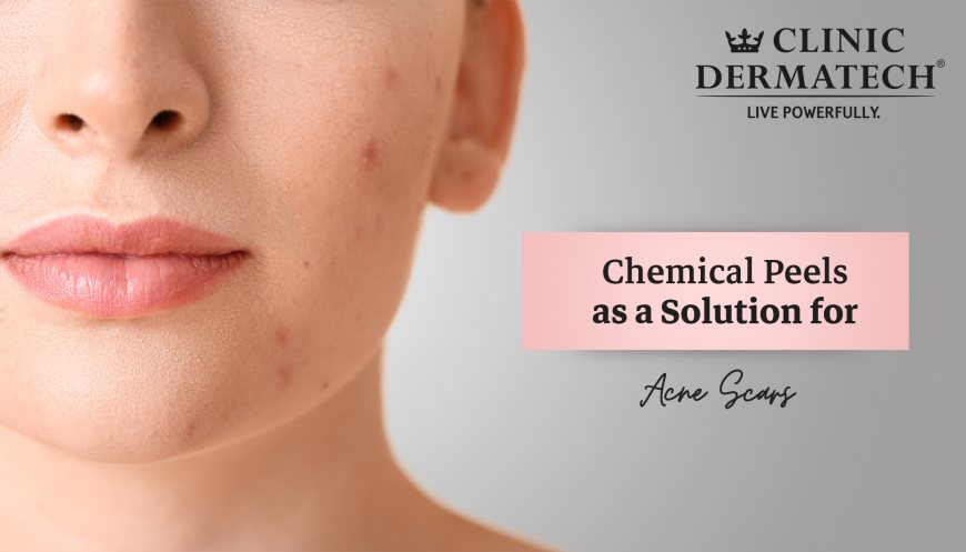 Chemical Peels as a Solution for Acne Scars at Clinic Dermatech